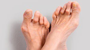 reumatische voet